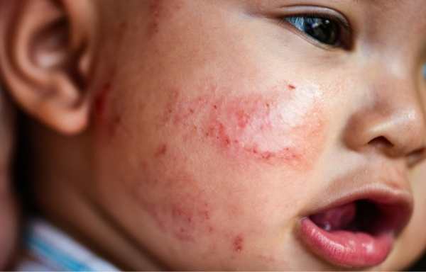Eczema Ke Karan - Causes Of Eczema In Hindi?
