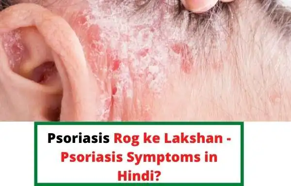 psoriasis symptoms | Psoriasis Konsi Bimari Hai - What Is Psoriasis In Hindi? | Psoriasis Rog ke Lakshan - Psoriasis Symptoms in Hindi?