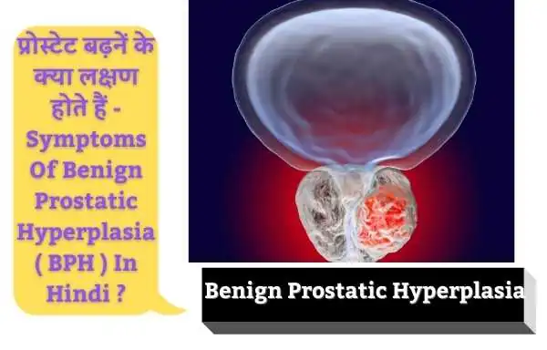 प्रोस्टेट बढ़नें के क्या लक्षण होते हैं | Symptoms Of Benign Prostatic Hyperplasia ( BPH ) In Hindi ?