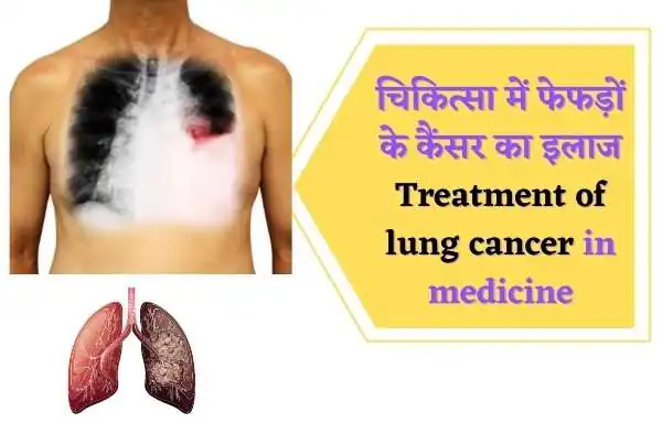 चिकित्सा में फेफड़ों के कैंसर का इलाज (Treatment of lung cancer in medicine):