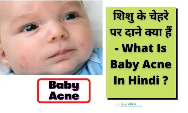 शिशु के चेहरे पर दाने क्या हैं - What Is Baby Acne In Hindi ?