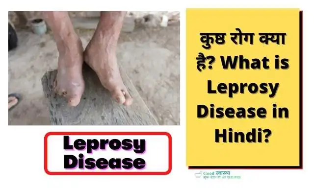 कुष्ठ रोग क्या है? (What is Leprosy Disease in Hindi?)