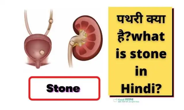 पथरी क्या है?(what is stone in hindi?)