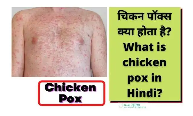 चिकन पॉक्स क्या होता है? (What is chicken pox in Hindi?)