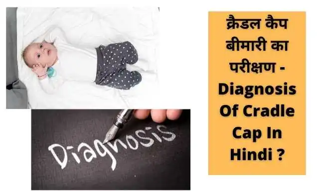 Cradle Cap Disease In Hindi 