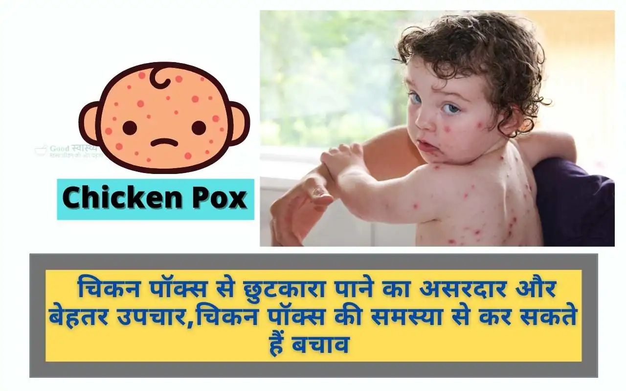 Chicken Pox : चिकन पॉक्स से छुटकारा पाने का असरदार और बेहतर उपचार, चिकन पॉक्स की समस्या से कर सकते हैं बचाव | Best Home Remedies and Treatments for Chicken Pox